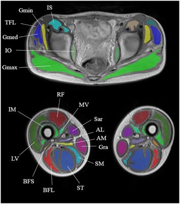 Efficacy and safety of hydrokinesitherapy in patients with dystrophinopathy